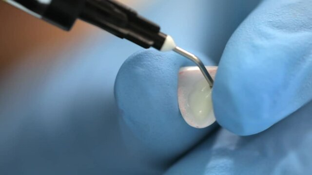The dentist applies material to the veneer