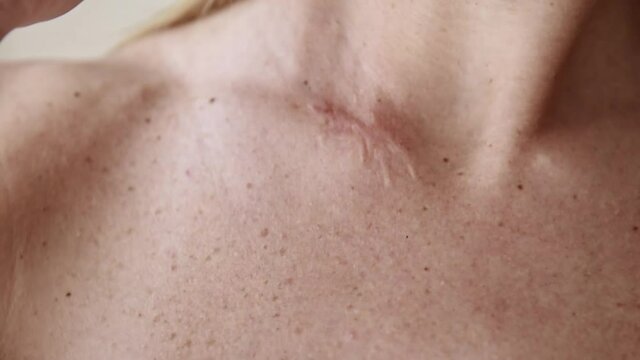 Close up surgery scar on beautiful woman neck.