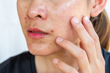 Cropped shot of worried woman having problems of acne inflamed on her face. Inflamed acne consists...