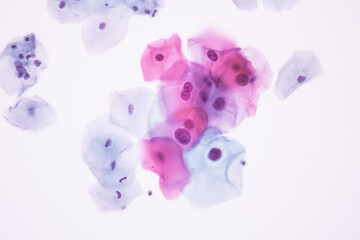 View in microscopic of Abnormal human cervix cells.Squamous epithelium cells.Superficial and intermediate epithelial cells.Cytology and pathology laboratory department.Magnification 400 X