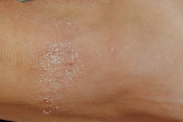 Fototapeta premium Allergic itchy skin.