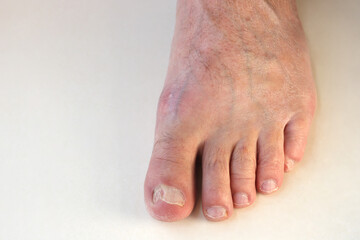 Male foot. Fungus of the nail. Damaged toenail of a man.