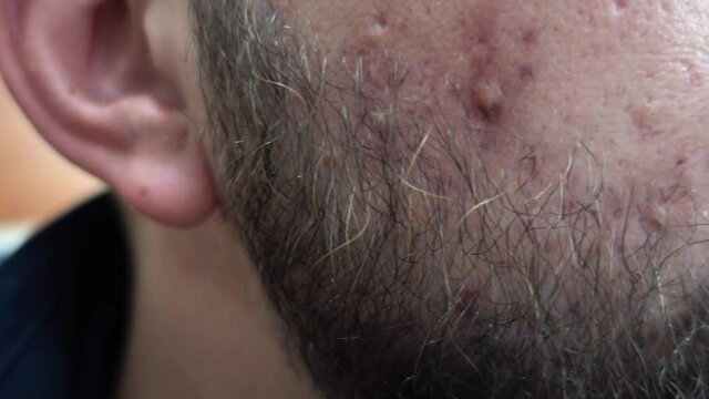 Close up on man face with problematic skin on his cheeks. Bearded young adult with acne problems. Redness, puffiness and pustules. Face inflammation on skin caused by allergy problems.