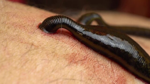 Medical leech on the human body drink blood. Treatment with leeches. Macro video.