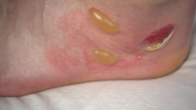 A close-up of a second-degree burn of a man's leg with hot water. The skin puffed up into balls.