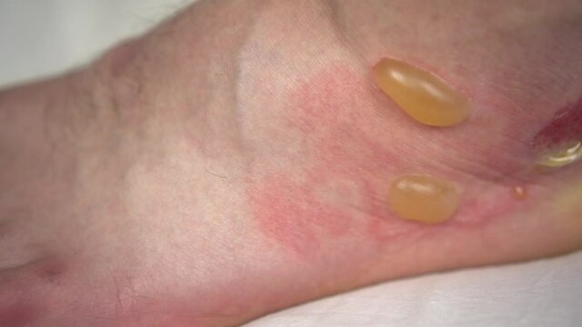 A close-up of a second-degree burn of a man's leg with hot water. The skin puffed up into balls.