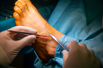 a surgeon sutures a wound on a foot with needle holder and thread