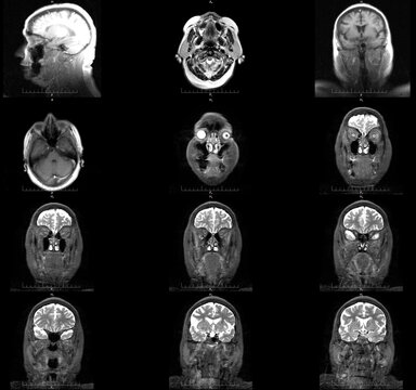Brain MRI , blood vessels, X-ray.