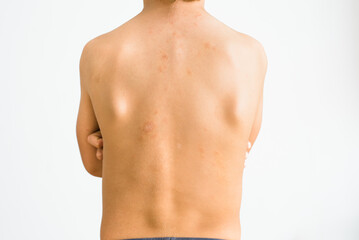 Fototapeta premium Back of a 7-year-old boy affected by pityriasis rosea gibert, a benign skin rash.