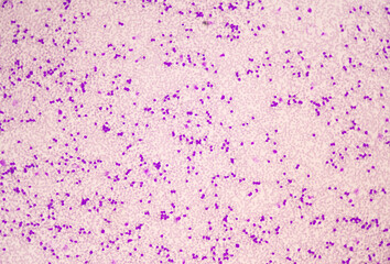 Moderate blast cell of white blood cells in blood smear.