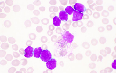 Fototapeta na wymiar Moderate blast cell of white blood cells in blood smear.