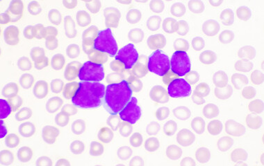 Moderate blast cell of white blood cells in blood smear.