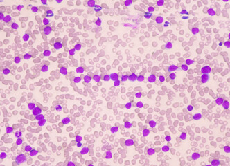 Moderate blast cell of white blood cells in blood smear.