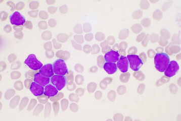 blast cell of white blood cells in blood smear.
