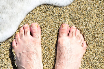 Man's foot with fungus infection on the sand 