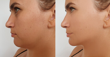 Obraz premium woman double chin before and after treatment