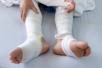 Bandage patient leg on hospital bed