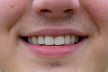 Close up on the teeth of a smiling young man