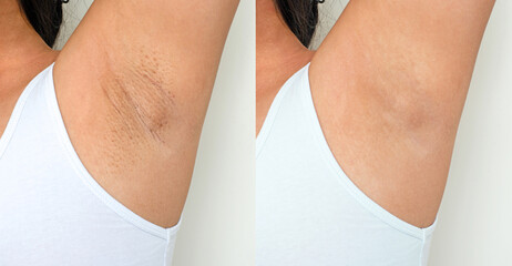 Black armpit skin in an Asian woman. Problem underarm rough chicken skin. Image before and after skincare cosmetology armpits epilation treatment concept. - obrazy, fototapety, plakaty