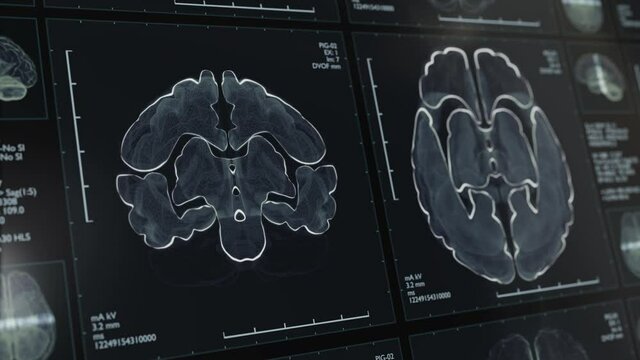 Magnetic resonance MRI or CT scan of brain.