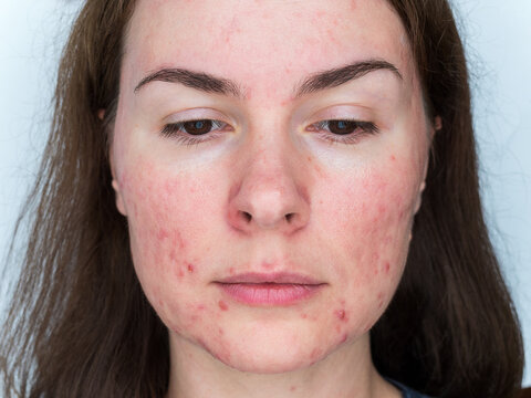papulopustular rosacea, close-up of the patient's face - the consequences of prolonged wearing of a mask