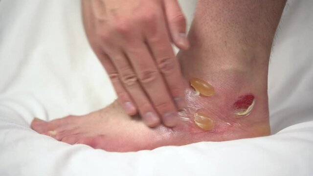 A man smears an ointment on a leg with a second-degree hot water burn. The skin was swollen in lumps.