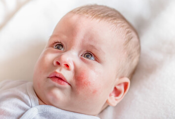 Atopic dermatitis eczema in baby.Condition that causes the skin to become red,dry,sore,itchy and...