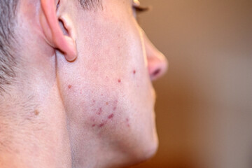 Profile of a teenager looking at his face in the mirror. Problems of the skin.