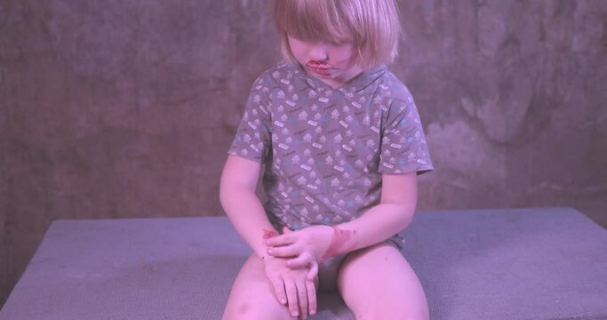 blond boy covered in blood. child has weak vessels in nose, bursting with pressure drops and changes in weather. Hemophilia disease.  kid raises her head to stop bleeding
