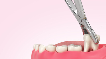 tooth clamped in medical extraction forceps dental services concept 3d render on color gradient