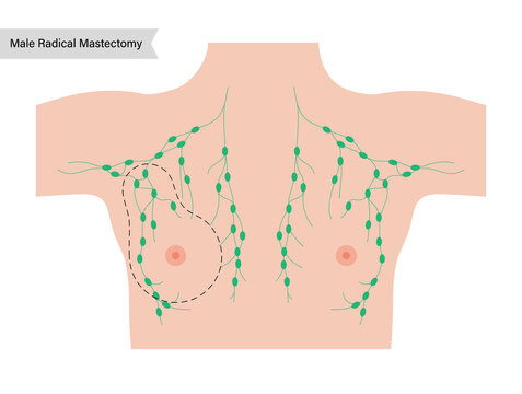 Breast disease concept