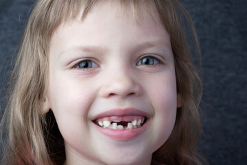 The smile of a child of six with growing molars. Change of deciduous teeth (baby, milk, temporary, primary teeth) to molars.