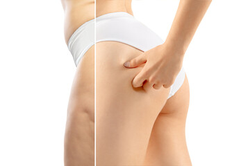 Overweight woman with cellulite legs and buttocks in white underwear comparing with fit and thin...