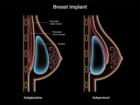 Breast Implant Concept