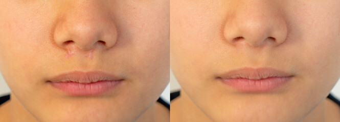 Horizontal image compare keloids scars treatment skin facial before and after laser treatments