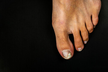 Toes of a female foot close-up with nails affected by a fungus on a black background. Foot health...