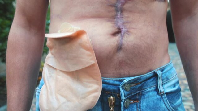 Scars on a man's body after surgery. Pouche and the stick-on appliances for colostomy routine care. The aftermath of police rubber bullets during the protests. 