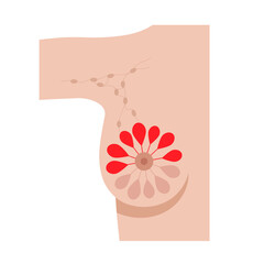 Obraz premium Breast disease concept