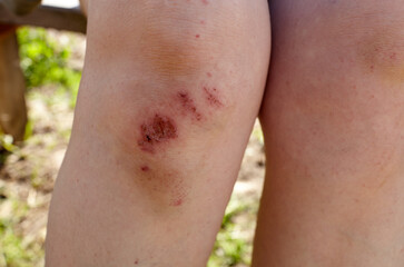 Sport injury - painful knee wound accident. Close up of bleeding scraped human knee after fallen on...