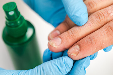 A dermatologist wearing gloves examines the skin of a sick patient. Examination and diagnosis of skin diseases-allergies, psoriasis, eczema, dermatitis