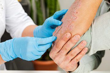 A dermatologist takes a skin analysis of a sick patient. Examination and diagnosis of skin diseases-allergies, psoriasis, eczema, dermatitis. - obrazy, fototapety, plakaty