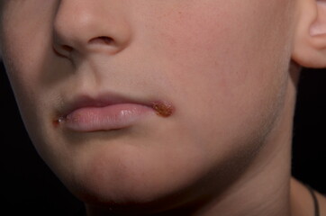 
infection on the lips angular cheilitis inflammation of both corners of the mouth