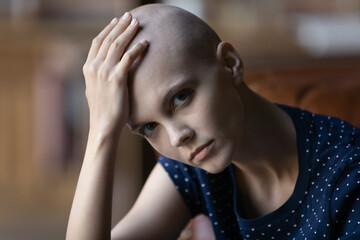 After effect of chemotherapy. Portrait of sad upset millennial woman having cancer diagnosis looking at camera touching caressing bald hairless head losing all hair after chemo or radiation treatment