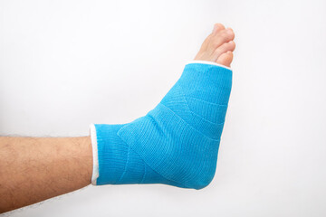 Bone fracture foot and leg on male patient close up.