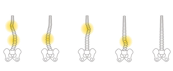 メディカル　姿勢（側弯症） 骨　上半身　背面