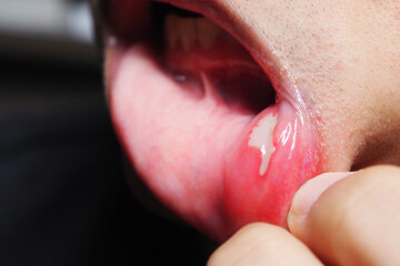 Painful Aphthous Ulcer with white or grey film inside of the human mouth from cut or bite while...