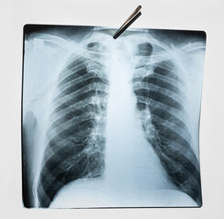 X-ray image of pneumonia against the background of the lamp