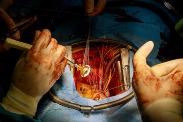 Obraz premium Open heart procedure, aortic valve surgery