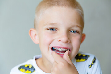 A blond boy inserts a baby orthodontic plate into his mouth. Close up	
