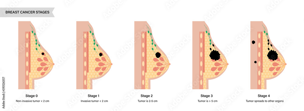 Sticker Breast disease concept